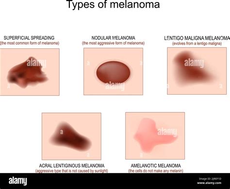 Types of skin cancer. Superficial spreading melanoma, Lentigo maligna ...