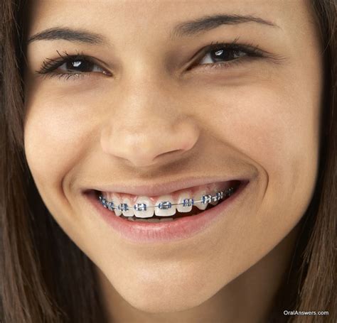 60 Photos of Teenagers with Braces | Oral Answers