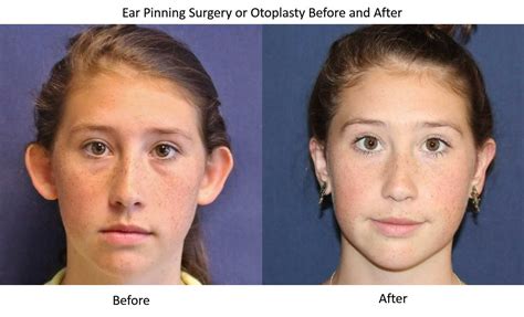 Otoplasty Seattle| Ear Pinning Surgery Kirkland | Dr Windle – DR. BRIAN ...