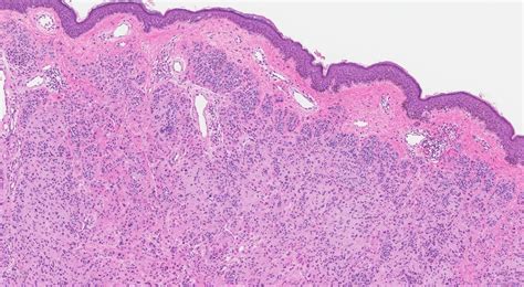 Dermal nevus | Ottawa Atlas of Pathology