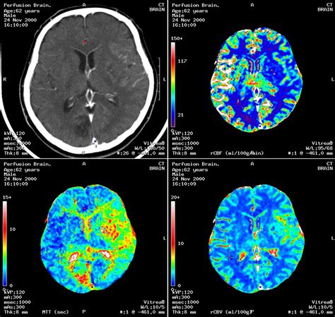 Brain Aneurysm Ct Scan - Diagnosis of a brain aneurysm may require ct ...