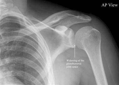 Posterior Shoulder Dislocation • LITFL • Trauma Library