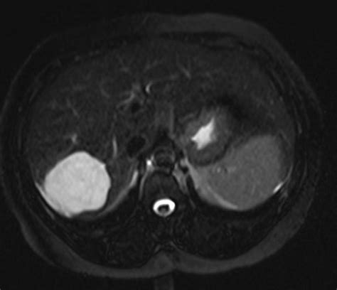 Hepatic hemangioma MRI - wikidoc