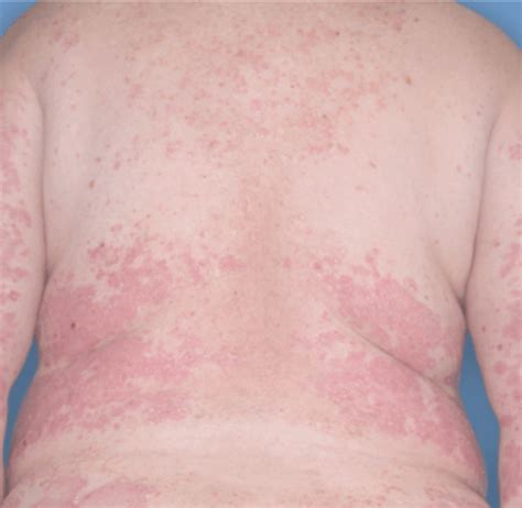 Plaque Psoriasis Results with ILUMYA® | ILUMYA® (tildrakizumab-asmn)