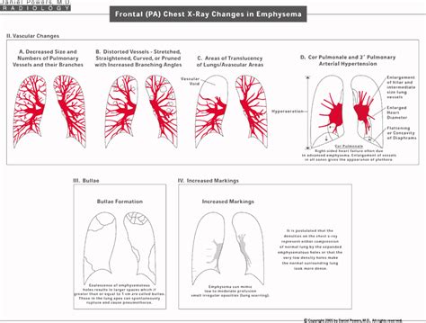 Emphysema Diagrams