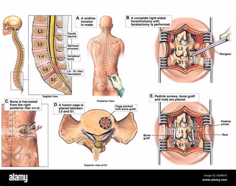 Lumbar disc herniation l5 s1 hi-res stock photography and images - Alamy