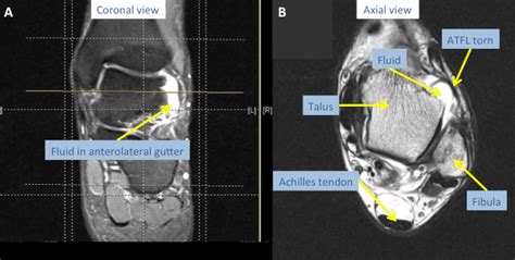 Medial Ankle Ligaments Mri