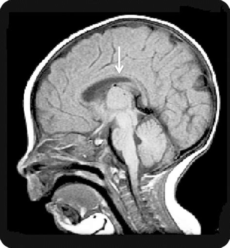 Head MRI at age 4 months Note thin corpus callosum (arrow). | Download ...