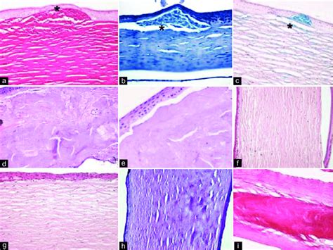 Photomicrographs showing various types of corneal dystrophies. (a-c ...