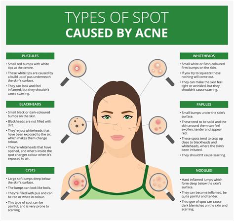 What Is Cystic Acne? | LloydsPharmacy Online Doctor UK