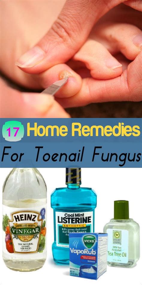 Health And Beauty - 17 Home Remedies For Toenail Fungus #2480869 - Weddbook