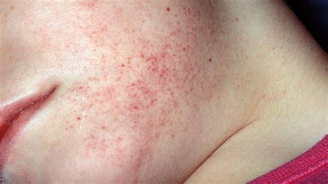 Leukemia Rash Pictures, Signs, and Symptoms | Everyday Health