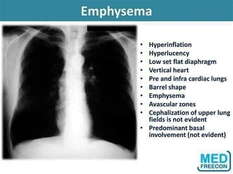 Chest X Ray Emphysema Findings