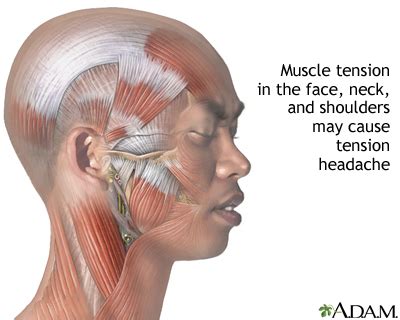 Tension headache | UF Health, University of Florida Health