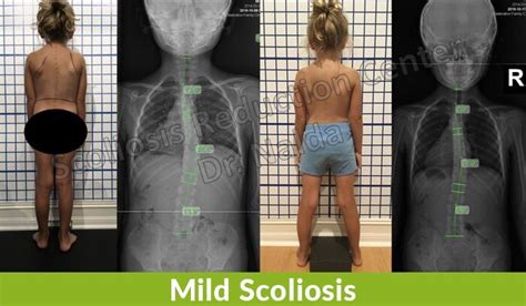 Mild Scoliosis - Symptoms, Treatment, and Surgery