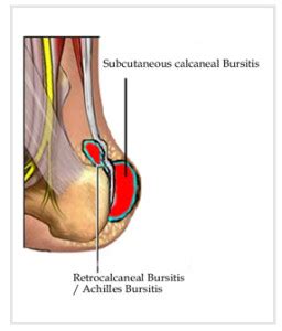 Achilles Bursitis Treatment | OSMO Patch US