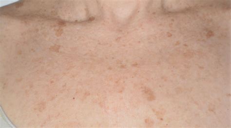 Seborrheic Keratosis | Pure Dermatology