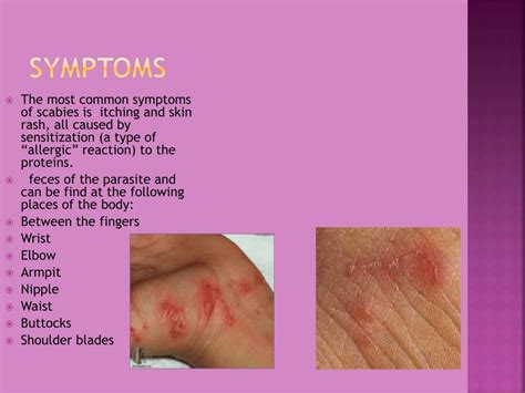 PPT - Scabies mite PowerPoint Presentation, free download - ID:2381798