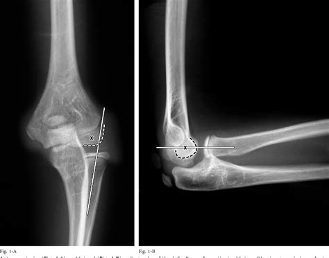 Figure 5 from Radial head dislocation and subluxation in osteogenesis ...