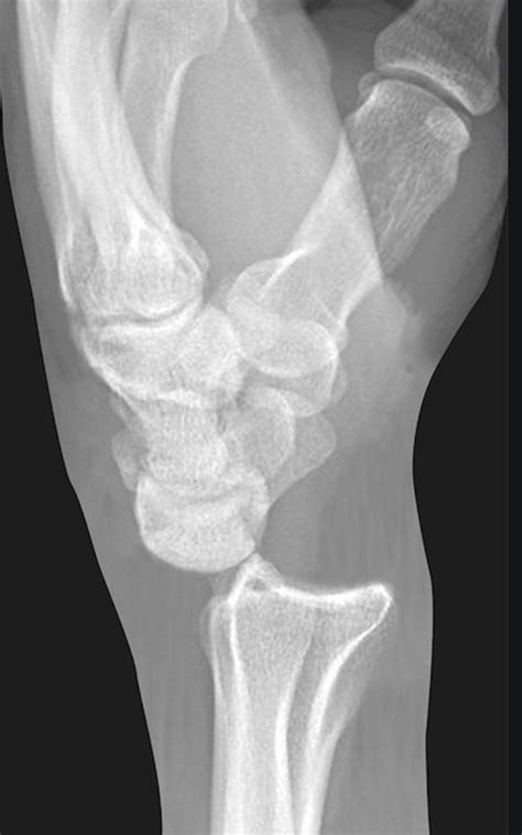 Radiocarpal Fracture Dislocation - Hand - Orthobullets