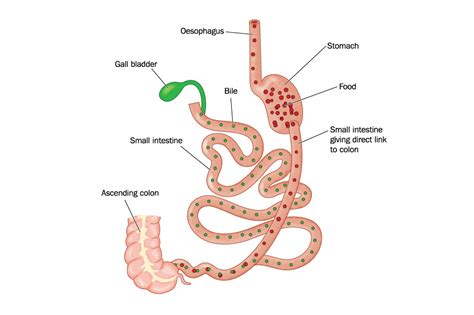 Duodenal Switch