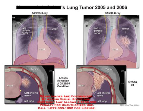 Lung Tumor Size Chart - Best Picture Of Chart Anyimage.Org