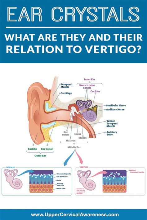 Ear Crystals What Are They and Relations To Vertigo - Upper Cervical ...