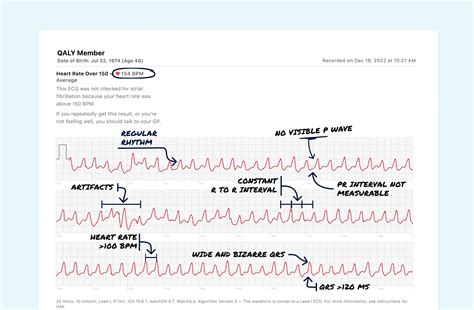 Supraventricular Tachycardia Sustained Vs Ventricular Tachycardia