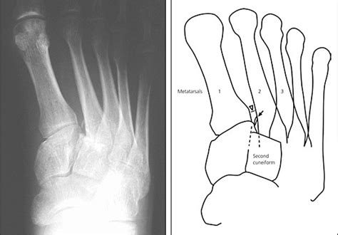 First Metatarsal Fracture