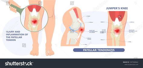 198 Patellar fracture Images, Stock Photos & Vectors | Shutterstock