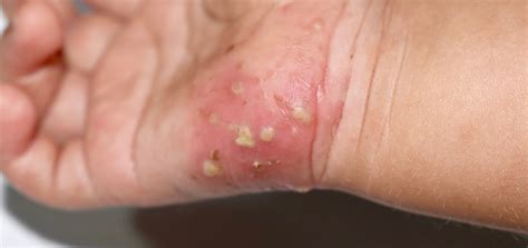 Scabies - Symptoms, Diagnosis, Treatment Choices - Dr Qaisar