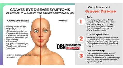 What is Graves Eye Disease? | OBN