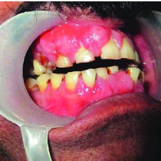 (PDF) Amlodipine Induced Gingival Hyperplasia – a Case Report and Review