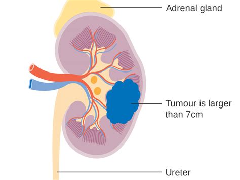 Kidney Cancer