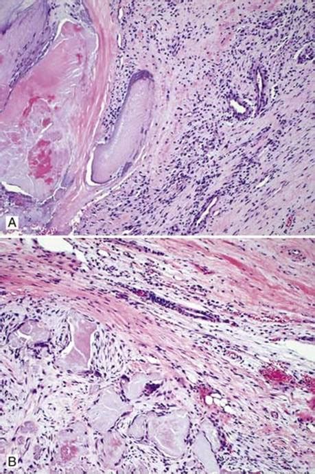 Aortic Valve Histology