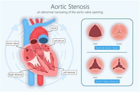 Aortic Valve Stenosis Symptoms and Treatment in Hyderabad