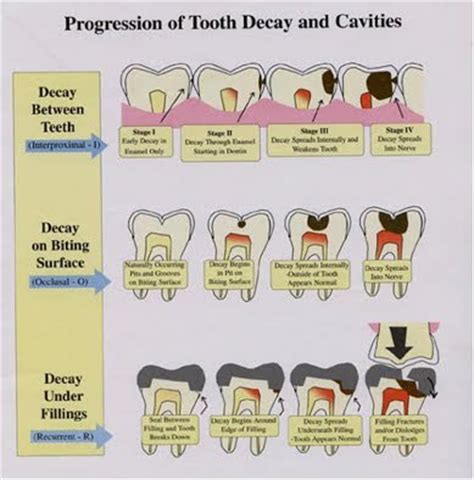 www.BestOgdenDentist.com Blog: Progression of tooth decay