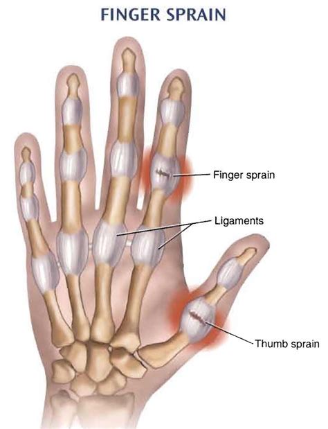 Neat Tips About How To Heal Sprained Finger - Householdother