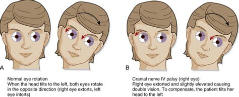 5th Cranial Nerve Palsy