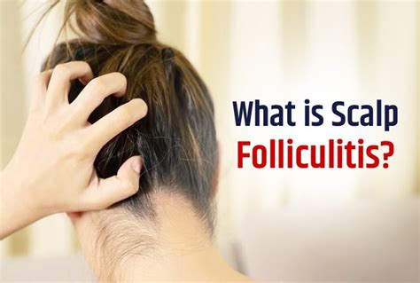 Folliculitis Scalp