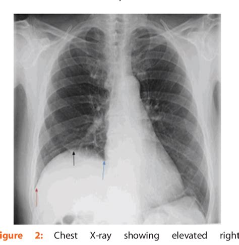 Figure 1 from Postoperative phrenic nerve palsy, a cause of prolonged ...