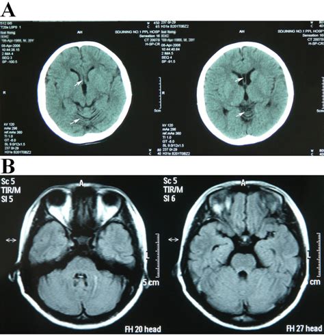 The CT scan and MRI scan results. A: CT scan of the proband’s brain ...