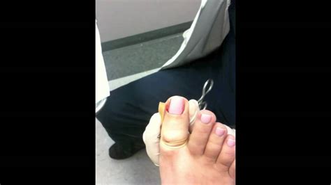 Ingrown Toenail Removal Aftercare Infection - Nail Ftempo