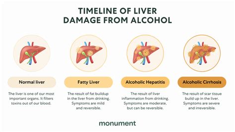 How Many Years of Drinking Alcohol Causes Liver Damage? | Monument