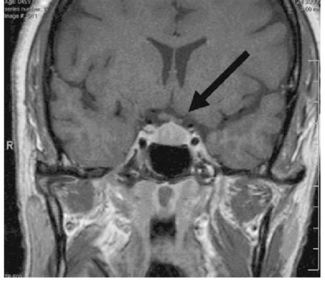 Pituitary Tumor Mri