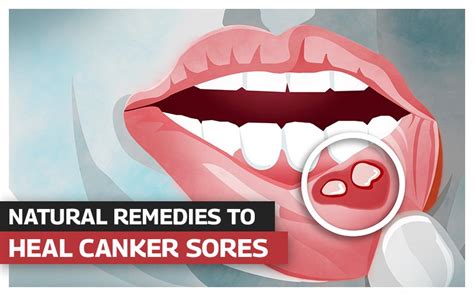 15 Home Remedies To Heal Canker Sores & Mouth Ulcers • Rodeo Dental