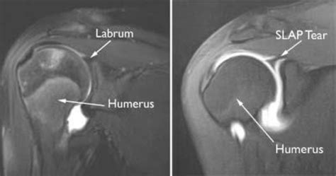 Posterior Labral tears and SLAP tears - Adam Watson Orthopaedic Surgeon