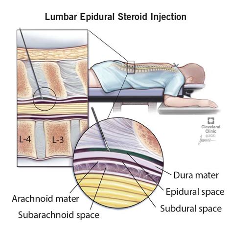 Lumbar Epidural Steroid Injections: What It Is, Benefits, Risks & Side ...