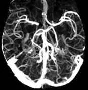 CT Angiogram - Imaging Glossary - Patients - UR Medicine Imaging ...