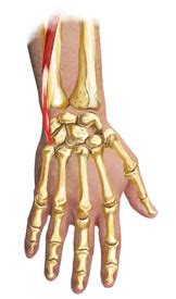 Extensor Carpi Ulnaris Tendonitis